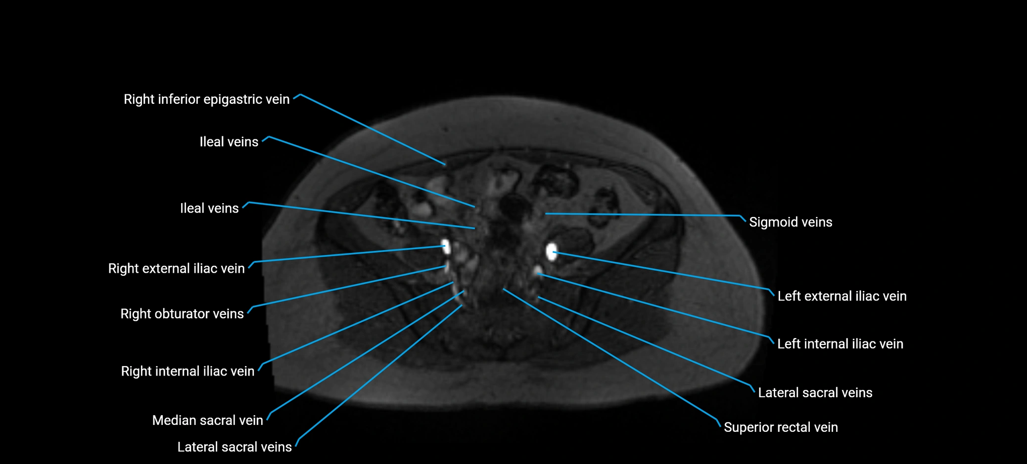 MRV abdomen pelvis & lower limb axial cross sectional anatomy labelled MRI image 138 (1).webp